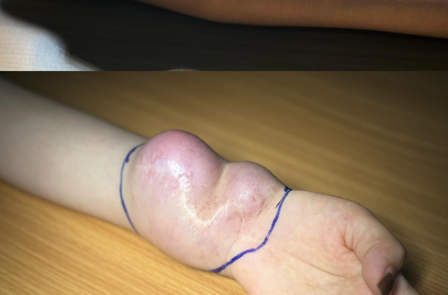 Đau cổ tay kéo dài, cô gái 23 tuổi bất ngờ phát hiện mắc ung thư - Ảnh 1.