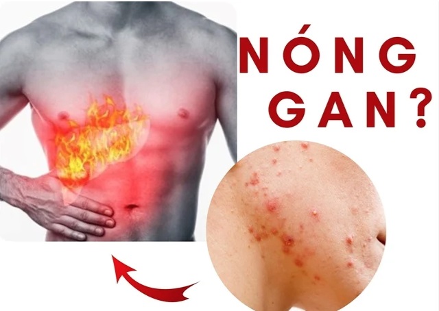 Mùa hè, 4 dấu hiệu cơ thể cảnh báo bạn đang bị nóng gan - Ảnh 2. Mùa hè, 4 dấu hiệu cơ thể cảnh báo bạn đang bị nóng gan - Ảnh 2.
