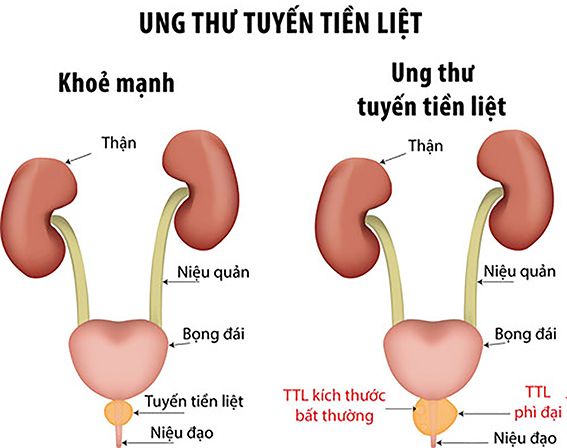 Dấu hiệu cảnh báo căn bệnh ung thư cựu Tổng thống Mỹ Joe Binden đang mắc phải, nam giới không nên chủ quan - Ảnh 2. Dấu hiệu cảnh báo căn bệnh ung thư cựu Tổng thống Mỹ Joe Binden đang mắc phải, nam giới không nên chủ quan - Ảnh 2.