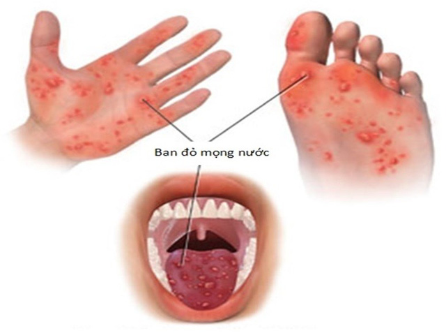 Bệnh tay chân miệng đang gia tăng, bố mẹ cần biết điều này để bảo vệ con - Ảnh 1. Bệnh tay chân miệng đang gia tăng, bố mẹ cần biết điều này để bảo vệ con - Ảnh 1.