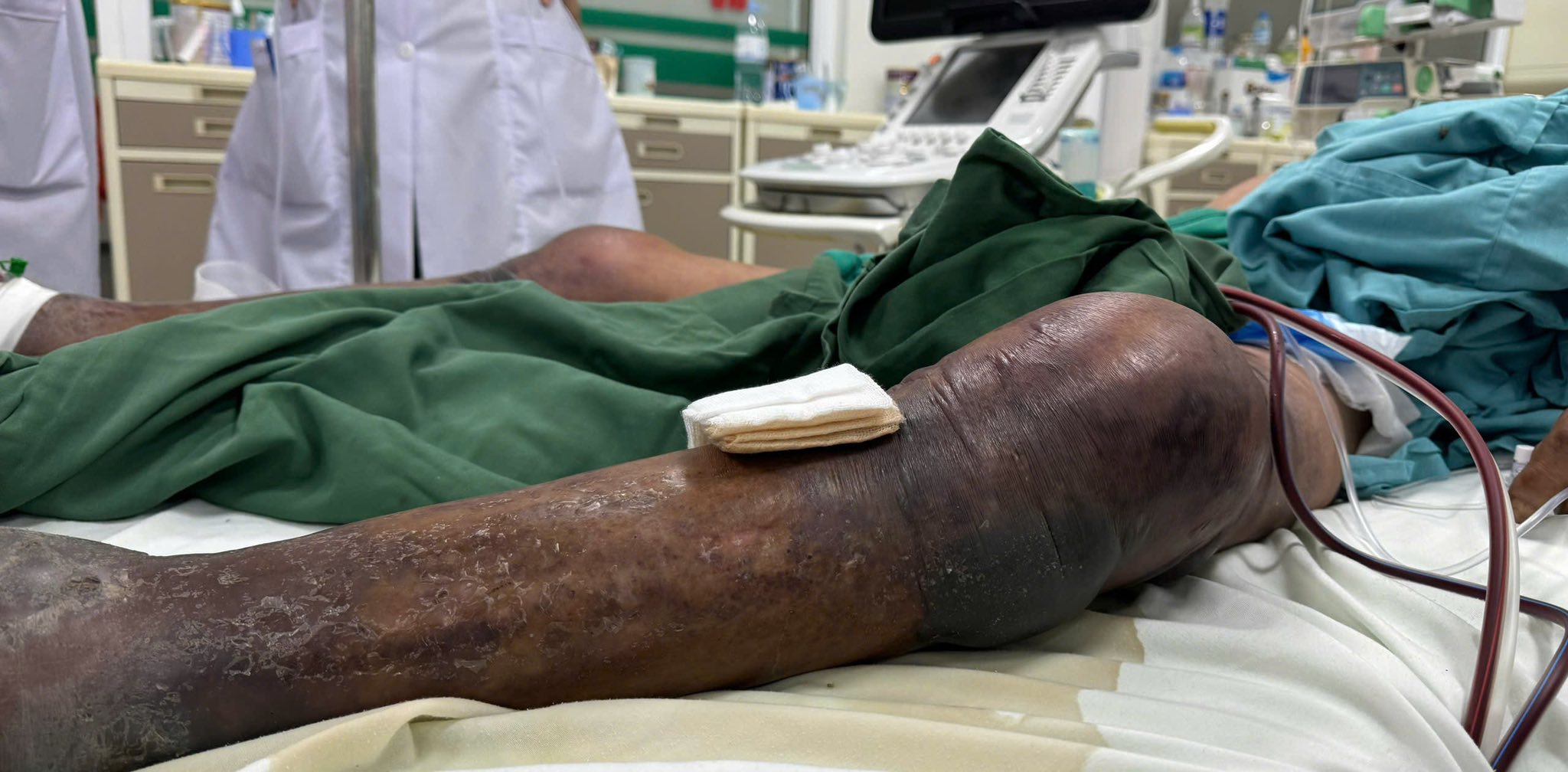 Người đàn ông ở Thanh Hóa nguy cơ hoại tử toàn thân, tiên lượng tử vong cao sau khi bị gai đâm vào chân - Ảnh 1.