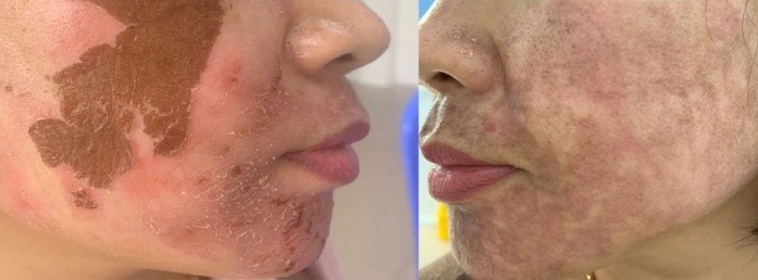 Trị nám 'cấp tốc': Trào lưu nguy hiểm từ các cơ sở thẩm mỹ 'chui' - Ảnh 1.