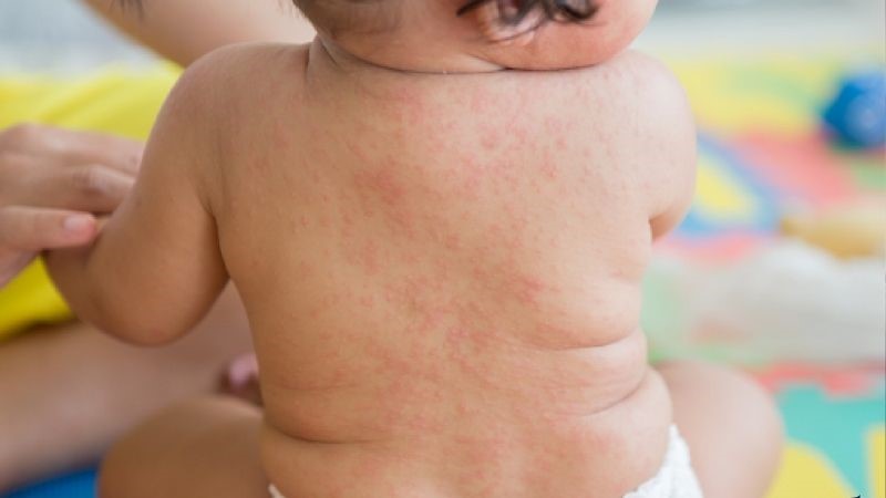Cách chăm sóc trẻ bị rôm sảy tại nhà- Ảnh 1.