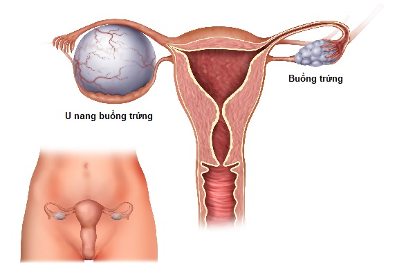 Nguyên nhân u nang xơ buồng trứng là gì?- Ảnh 1. Nguyên nhân u nang xơ buồng trứng là gì?- Ảnh 1.