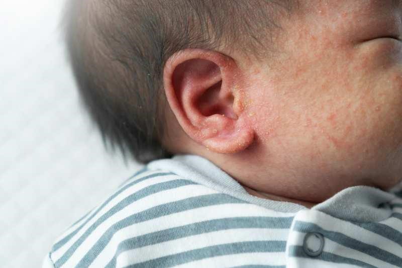 Cách chăm sóc trẻ bị rôm sảy tại nhà- Ảnh 2.
