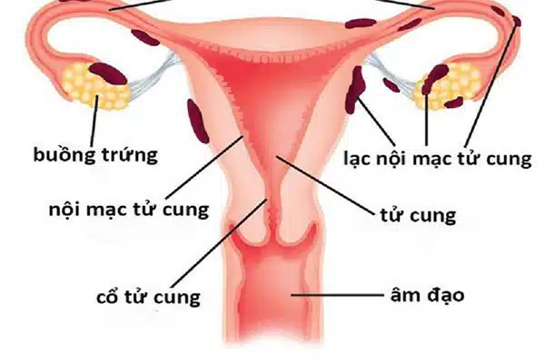 Nguyên nhân u nang xơ buồng trứng là gì?- Ảnh 3. Nguyên nhân u nang xơ buồng trứng là gì?- Ảnh 3.