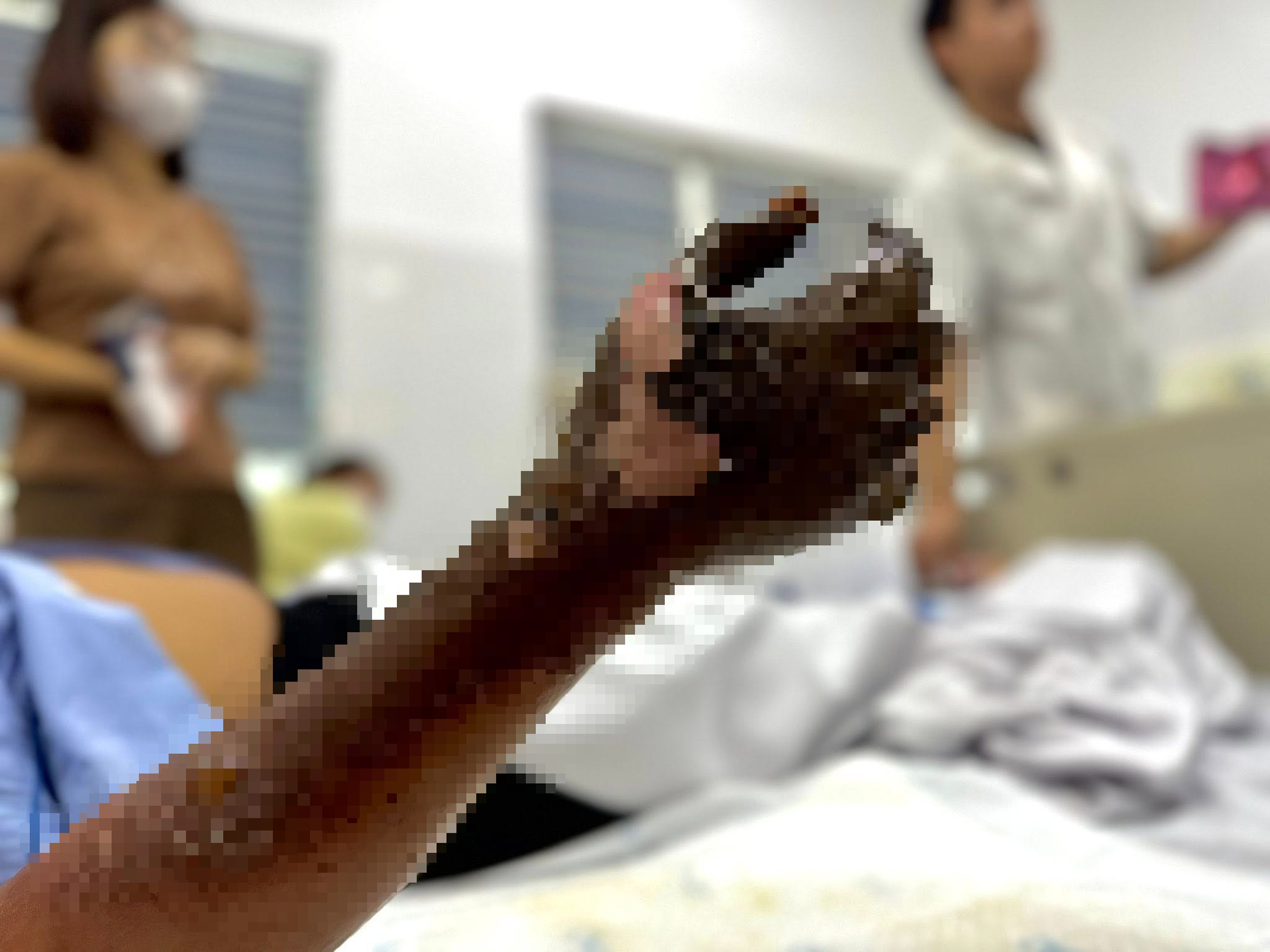 Nam thợ điện thoát chết sau khi bị điện giật cháy đen bàn tay- Ảnh 2.