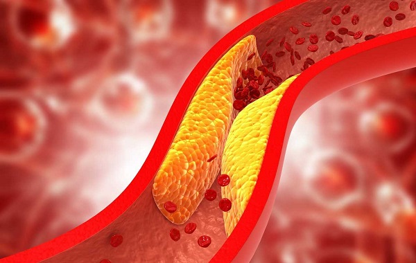 Người phụ nữ 31 tuổi triglyceride trong máu vượt quá 45 lần, thừa nhận 1 sai lầm nhiều người Việt mắc phải - Ảnh 3. Người phụ nữ 31 tuổi triglyceride trong máu vượt quá 45 lần, thừa nhận 1 sai lầm nhiều người Việt mắc phải - Ảnh 3.