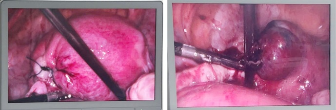 Người phụ nữ 36 tuổi nhập viện vì thai ngoài tử cung vỡ, thừa nhận một sai lầm nhiều phụ nữ Việt mắc phải - Ảnh 2.