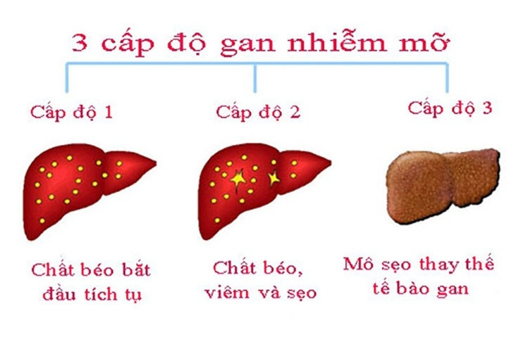 6 cách ngăn ngừa và kiểm soát bệnh gan nhiễm mỡ an toàn và hiệu quả- Ảnh 2.