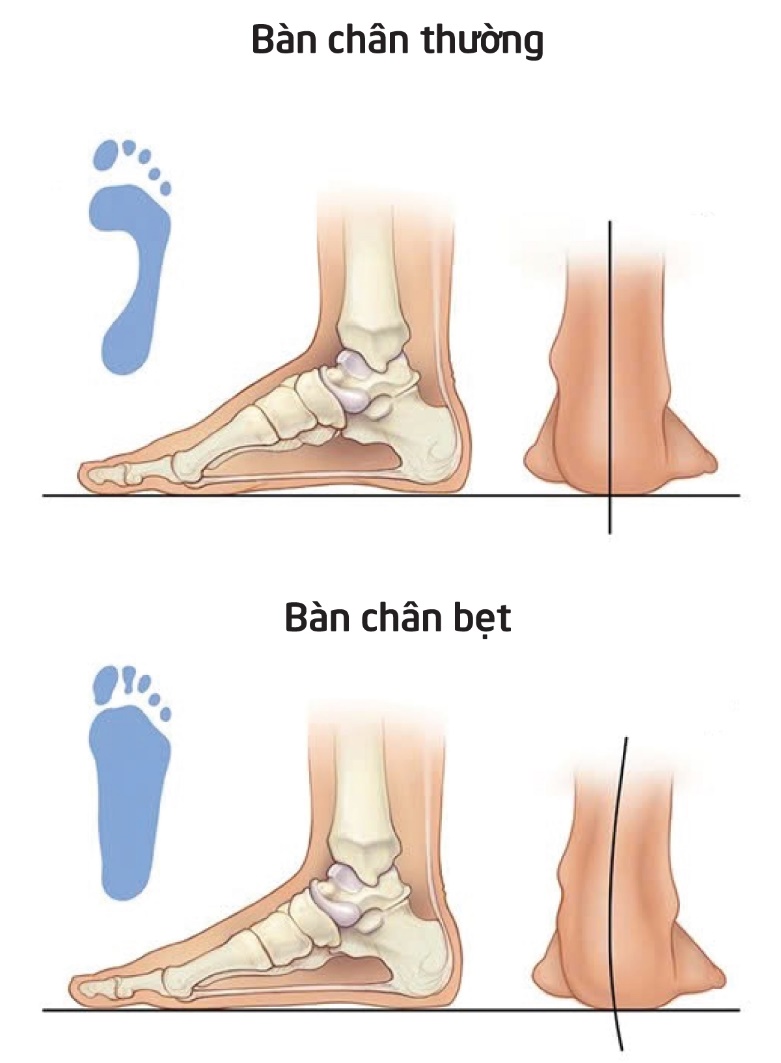 Sưng đau cổ chân phải sau khi chơi bóng rổ, tái phát nhiều lần, bé trai 11 tuổi được phát hiện có bàn chân bẹt hai bên - Ảnh 1. Sưng đau cổ chân phải sau khi chơi bóng rổ, tái phát nhiều lần, bé trai 11 tuổi được phát hiện có bàn chân bẹt hai bên - Ảnh 1.