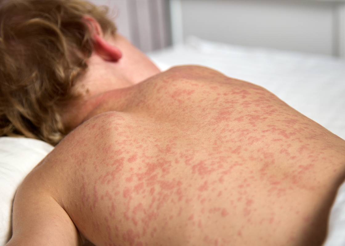 Cảnh giác với dấu hiệu bệnh sởi ở trẻ- Ảnh 2.