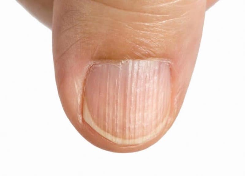 Nếu móng tay có dấu hiệu này, cẩn thận với ung thư hắc tố- Ảnh 4. Nếu móng tay có dấu hiệu này, cẩn thận với ung thư hắc tố- Ảnh 4.