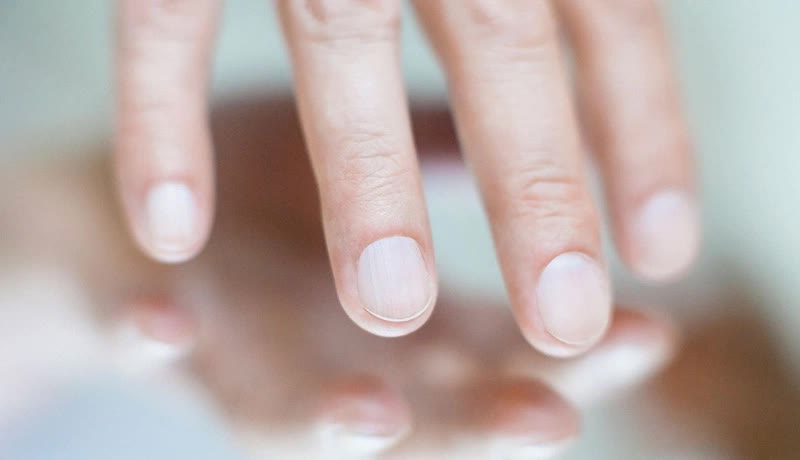 Nếu móng tay có dấu hiệu này, cẩn thận với ung thư hắc tố- Ảnh 2. Nếu móng tay có dấu hiệu này, cẩn thận với ung thư hắc tố- Ảnh 2.