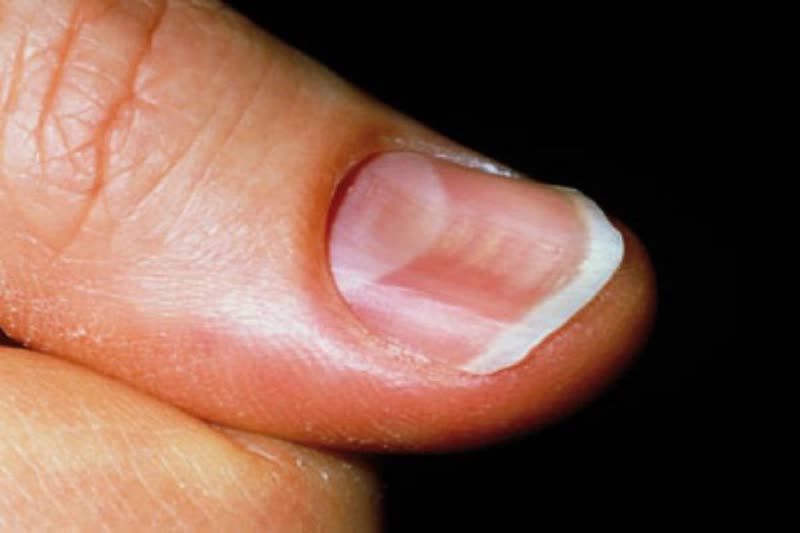 Nếu móng tay có dấu hiệu này, cẩn thận với ung thư hắc tố- Ảnh 3. Nếu móng tay có dấu hiệu này, cẩn thận với ung thư hắc tố- Ảnh 3.