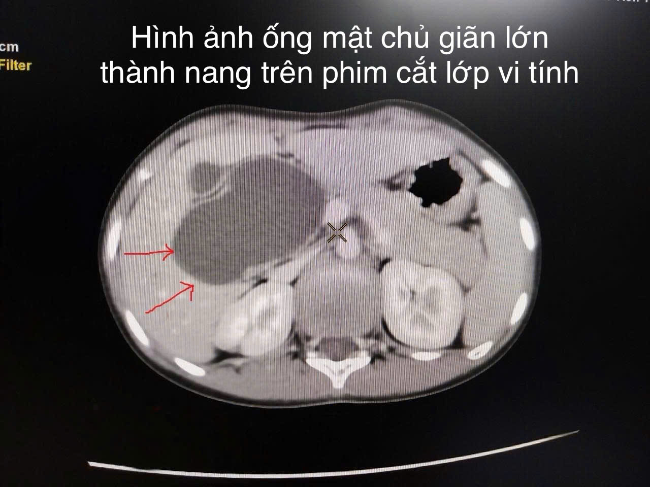 Bệnh viện Trẻ em Hải Phòng nội soi cắt nang ống mật chủ lớn cho bệnh nhi 10 tuổi- Ảnh 1. Bệnh viện Trẻ em Hải Phòng nội soi cắt nang ống mật chủ lớn cho bệnh nhi 10 tuổi- Ảnh 1.