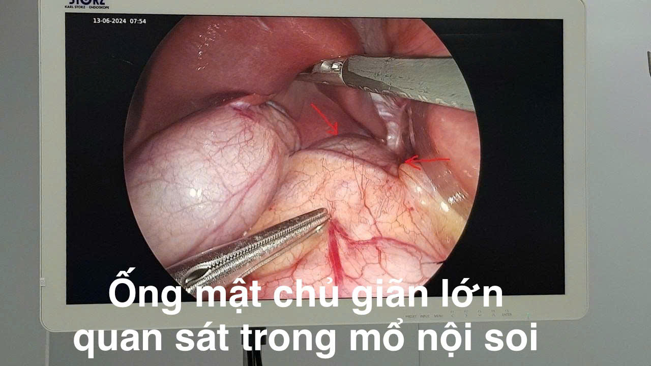 Bệnh viện Trẻ em Hải Phòng nội soi cắt nang ống mật chủ lớn cho bệnh nhi 10 tuổi- Ảnh 2. Bệnh viện Trẻ em Hải Phòng nội soi cắt nang ống mật chủ lớn cho bệnh nhi 10 tuổi- Ảnh 2.