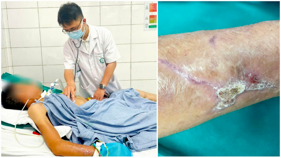 Người đàn ông 65 tuổi co giật, cứng hàm sau cú ngã đập tay vào thanh gỗ- Ảnh 1. Người đàn ông 65 tuổi co giật, cứng hàm sau cú ngã đập tay vào thanh gỗ- Ảnh 1.