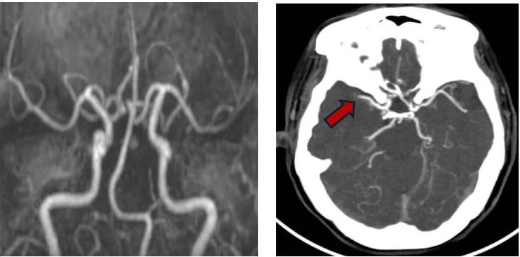 Người phụ nữ 57 tuổi đột quỵ liên tiếp 2 lần trong 2 ngày thừa nhận bỏ qua dấu hiệu báo bệnh này - Ảnh 2.