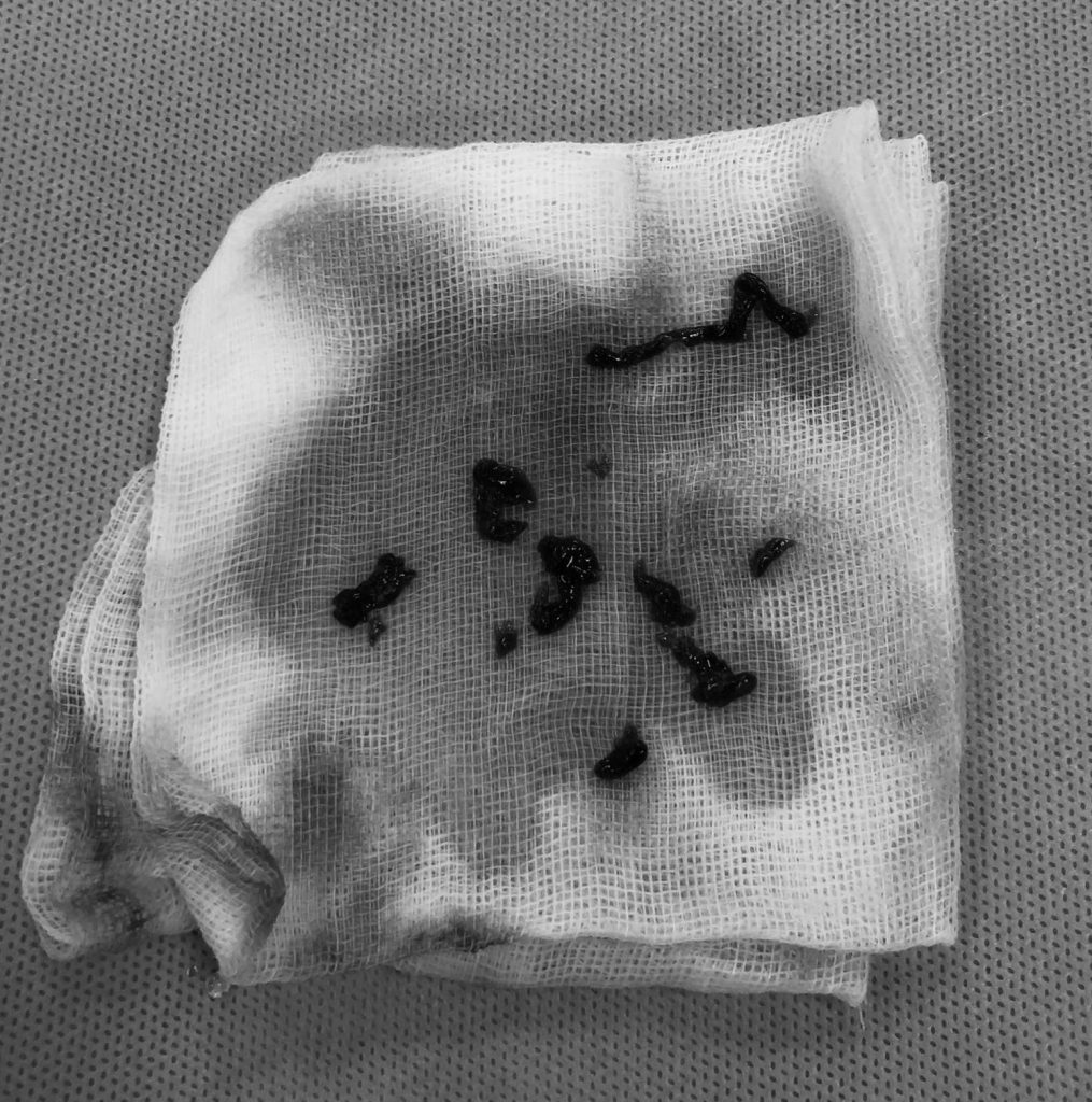 Phòng ngừa đột qụy hiệu quả từ câu chuyện của người phụ nữ 43 tuổi ở Củ Chi - Ảnh 3.