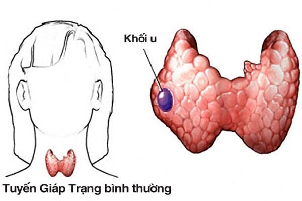 hinh-anh-ung-thu-tuyen-giap2-600x400-1-1750326972455-1750326973066896534529.jpg