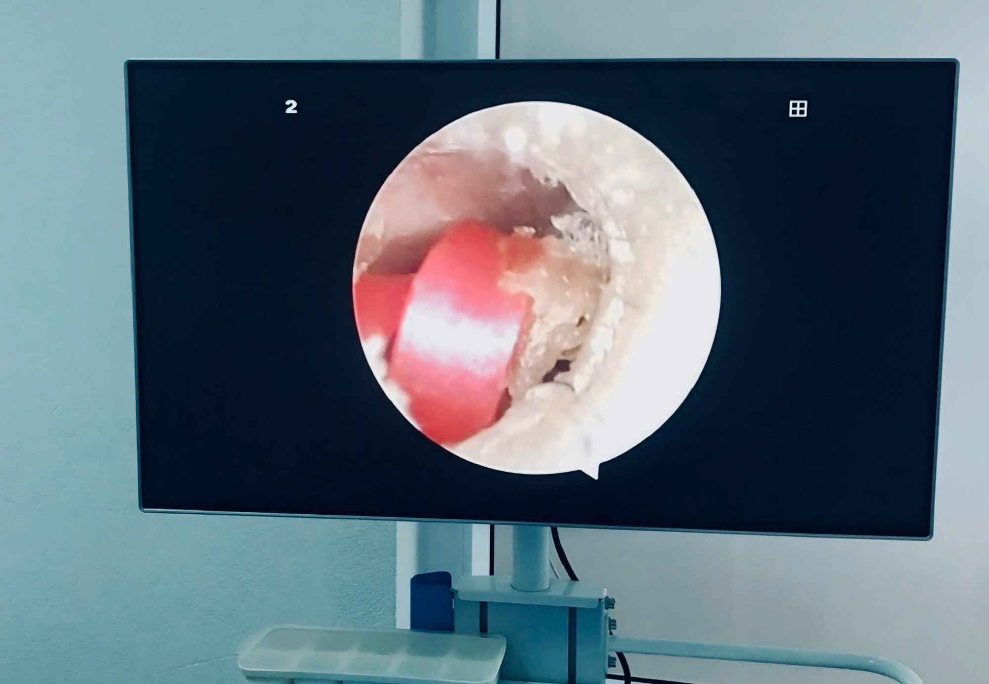 Bé gái 6 tuổi đi viện do sợi dây chun buộc tóc - Ảnh 2.