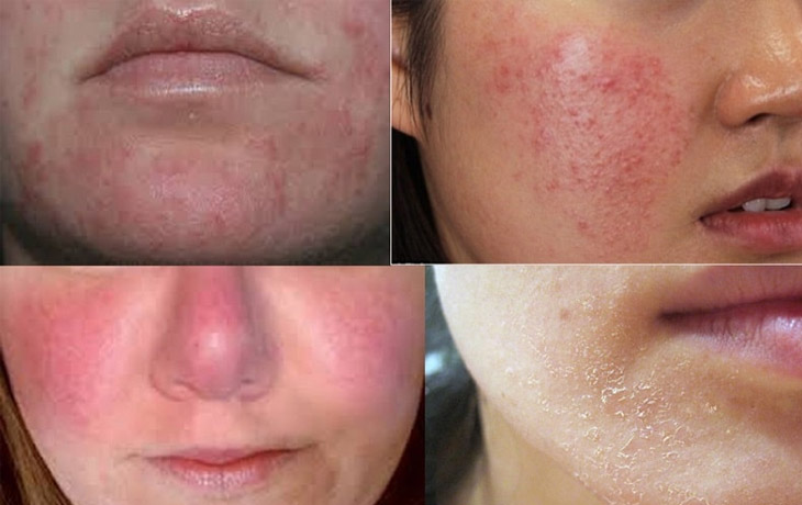 than-trong-voi-nguy-co-gay-kich-ung-cua-retinol-1749880887716790274438-1750409061559-17504090617821328778897.jpg