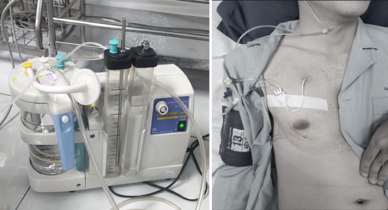 Thanh niên 25 tuổi ở Hà Nội nhập viện vì tràn khí màng phổi khi tập gym từng mắc bệnh này, ai có dấu hiệu cần cảnh giác! - Ảnh 2.