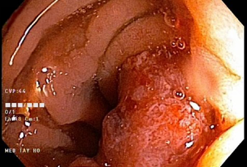 Người đàn ông 67 tuổi ở Hà Nội phát hiện ung thư đại tràng thừa nhận chủ quan với dấu hiệu báo bệnh này - Ảnh 2.