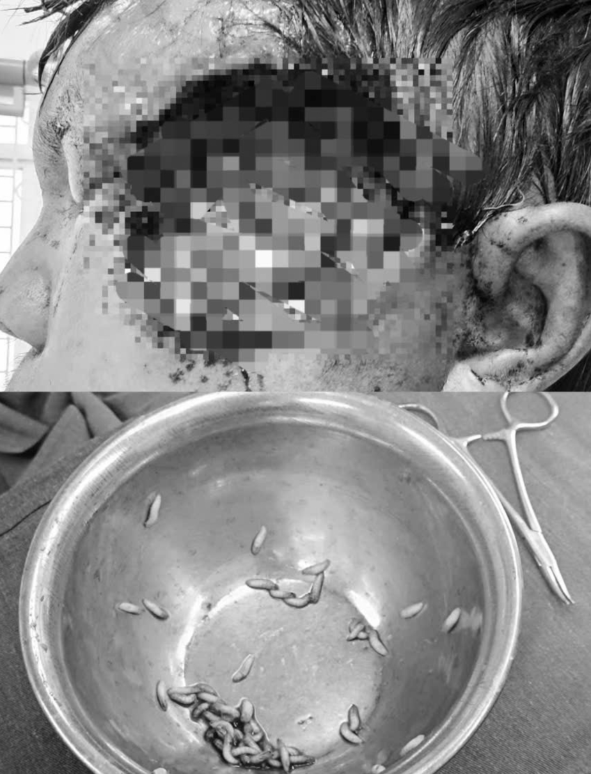 Dòi bò lúc nhúc trên mặt người đàn ông do đổ thuốc diệt cỏ vào má và những cách chữa bệnh tai hại không giống ai! - Ảnh 1. Dòi bò lúc nhúc trên mặt người đàn ông do đổ thuốc diệt cỏ vào má và những cách chữa bệnh tai hại không giống ai! - Ảnh 1.