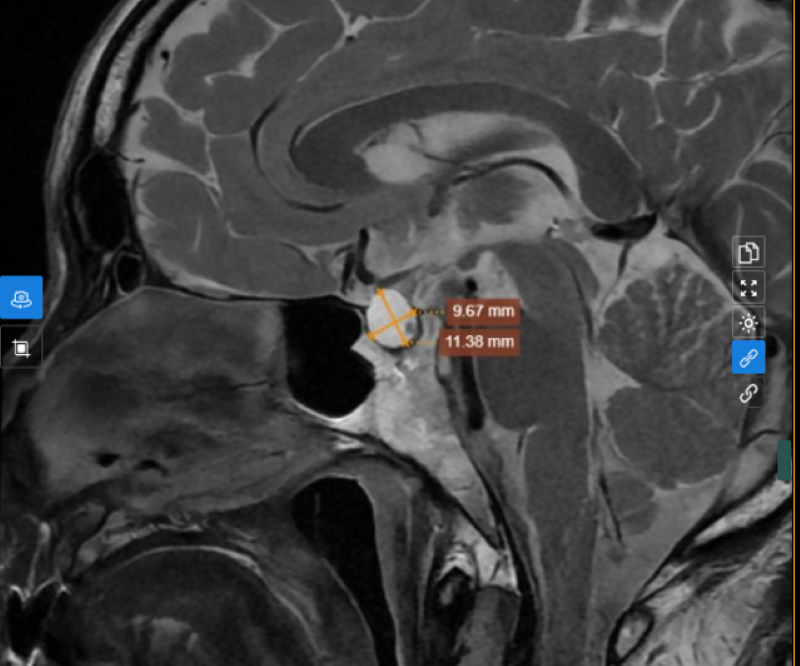 Người đàn ông 64 tuổi ở Hà Nội phát hiện u tuyến yên từ dấu hiệu nhiều người Việt bỏ qua - Ảnh 2. Người đàn ông 64 tuổi ở Hà Nội phát hiện u tuyến yên từ dấu hiệu nhiều người Việt bỏ qua - Ảnh 2.