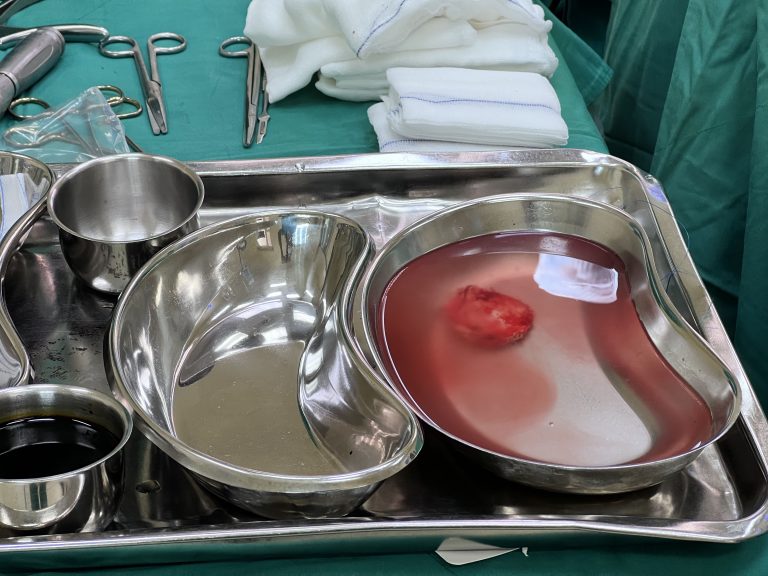 Người phụ nữ 48 tuổi phát hiện u não to như quả quýt từ dấu hiệu nhiều người Việt bỏ qua - Ảnh 3.