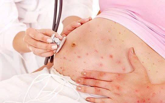 Mắc sởi khi mang thai, người phụ nữ 26 tuổi sinh non ở tuần 31