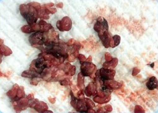 Phát hiện hàng trăm polyp bám chi chít trong ruột nam sinh 17 tuổi từ dấu hiệu nhiều người Việt bỏ qua - Ảnh 3. Phát hiện hàng trăm polyp bám chi chít trong ruột nam sinh 17 tuổi từ dấu hiệu nhiều người Việt bỏ qua - Ảnh 3.