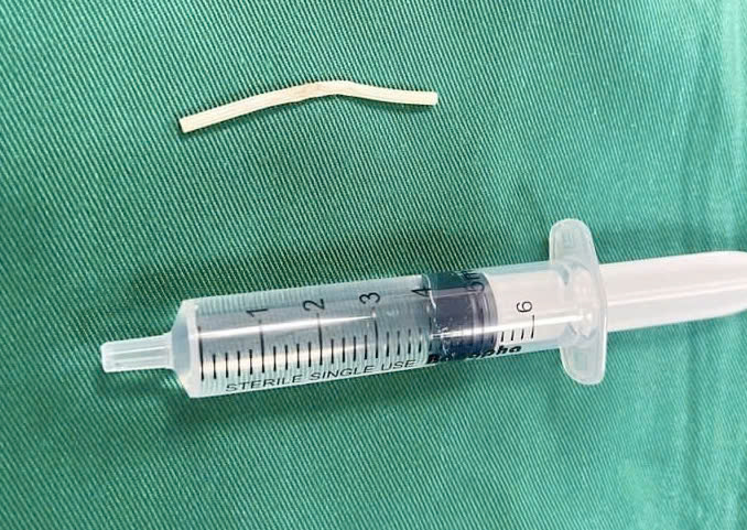 Người phụ nữ 35 tuổi ở Hải Dương phải phẫu thuật vì que tránh thai 'đi lạc' trong cánh tay- Ảnh 2.