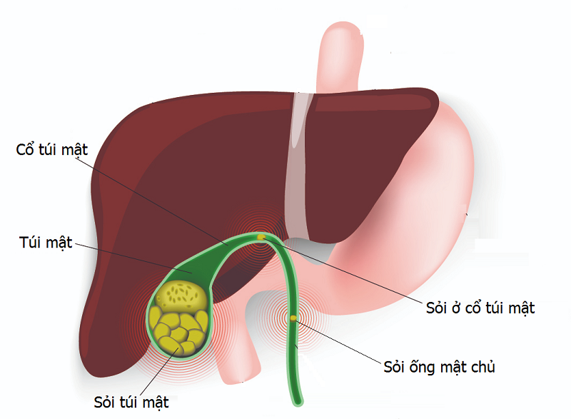 Sỏi mật - Tất cả những điều bạn cần biết- Ảnh 1. Sỏi mật - Tất cả những điều bạn cần biết- Ảnh 1.