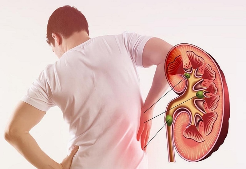 Người đàn ông bị suy thận mạn - Ảnh 2.
