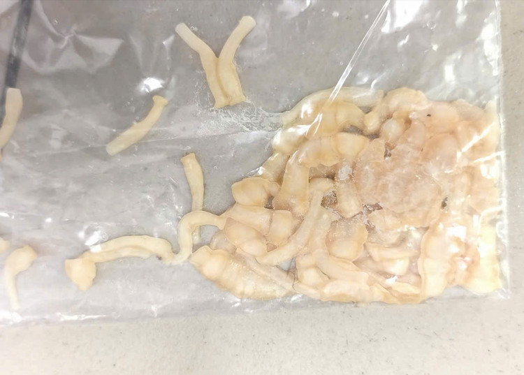 Nam thanh niên 30 tuổi ở Phú Thọ có sán dây dài hơn 3 mét do thường xuyên ăn món quen thuộc này- Ảnh 1.