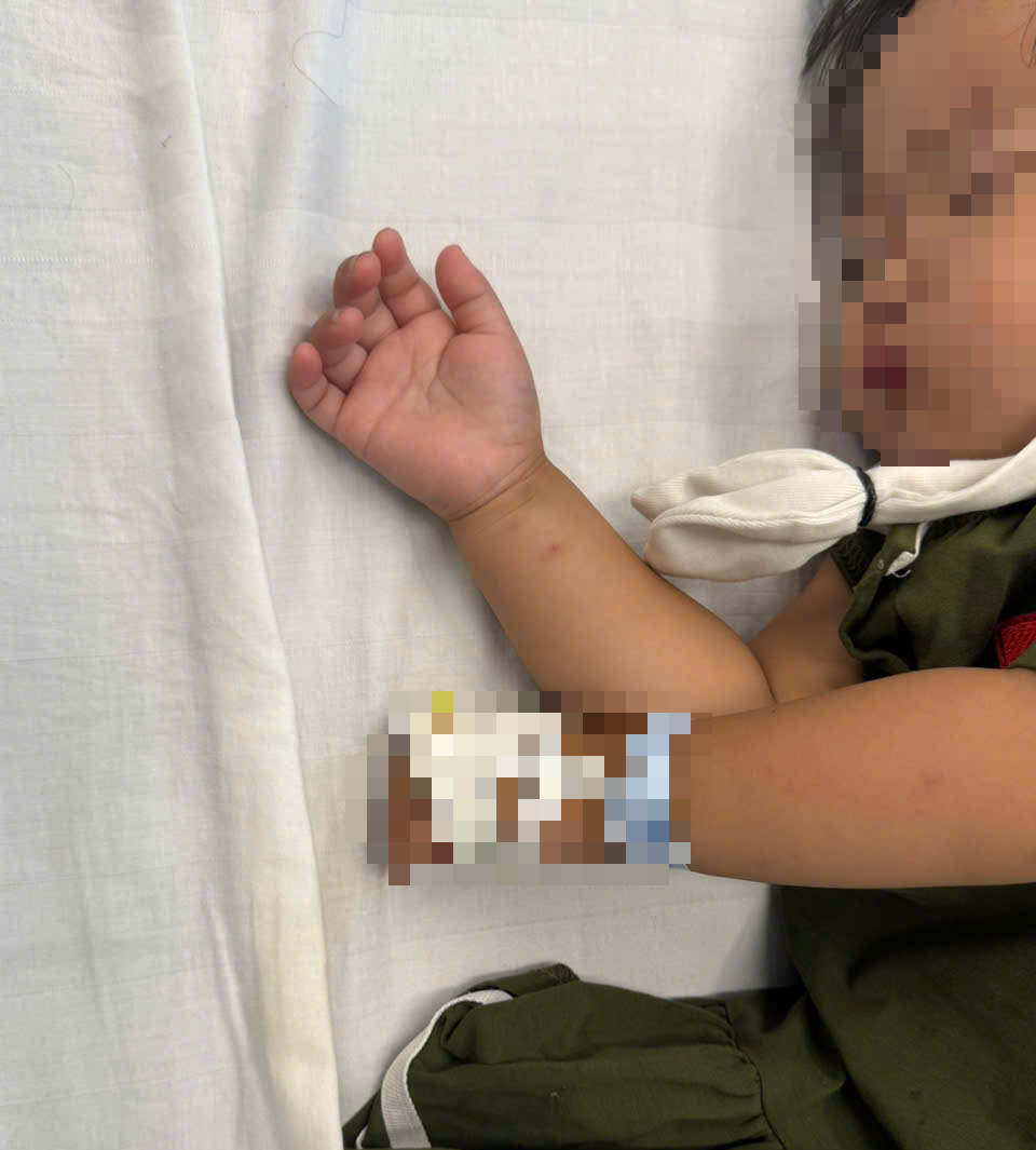 Bé gái hơn 2 tuổi nhập viện gấp do tai nạn tại nhà hay gặp ở trẻ nhỏ- Ảnh 1.