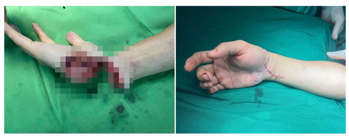 Cứu đôi tay Tiktoker ở Thái Nguyên qua lời kể của bác sĩ - Ảnh 1. Cứu đôi tay Tiktoker ở Thái Nguyên qua lời kể của bác sĩ - Ảnh 1.