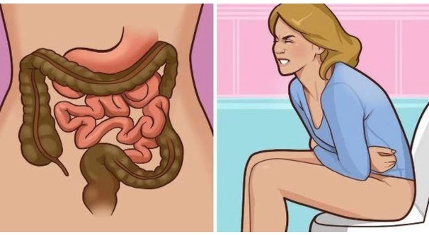 8 dấu hiệu ung thư trực tràng dễ nhận biết nhưng thường bị bỏ qua- Ảnh 1.