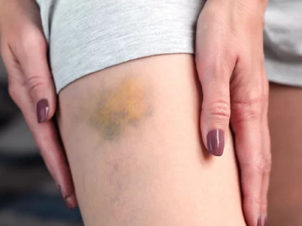 Vết bầm t&iacute;m xuất hiện tr&ecirc;n da nếu k&egrave;m dấu hiệu n&agrave;y cần được kh&aacute;m sớm