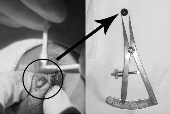 Ca bệnh hi hữu: Viên bi sắt 6mm nằm trong mí mắt nam sinh 15 tuổi ở Ninh Bình suốt nhiều ngày- Ảnh 1.