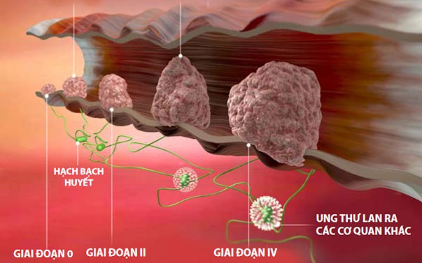 ung-thu-dai-trang-giai-doan-4-1753491280408924104581-32-0-409-603-crop-1753491403004253343840.jpg