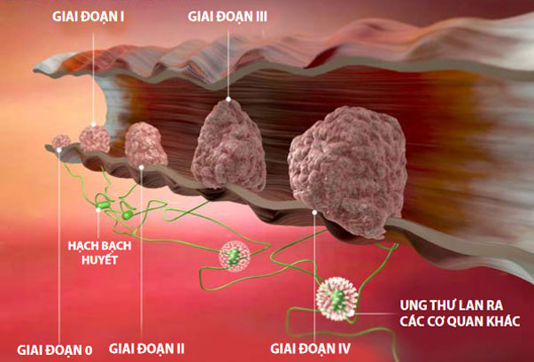 Người đàn ông ung thư đại tràng giai đoạn 4 ân hận vì không làm việc này dù đã được cảnh cáo trước - Ảnh 2. Người đàn ông ung thư đại tràng giai đoạn 4 ân hận vì không làm việc này dù đã được cảnh cáo trước - Ảnh 2.
