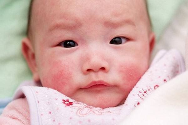 Làm gì khi trẻ bị viêm da? - Ảnh 1. Làm gì khi trẻ bị viêm da? - Ảnh 1.