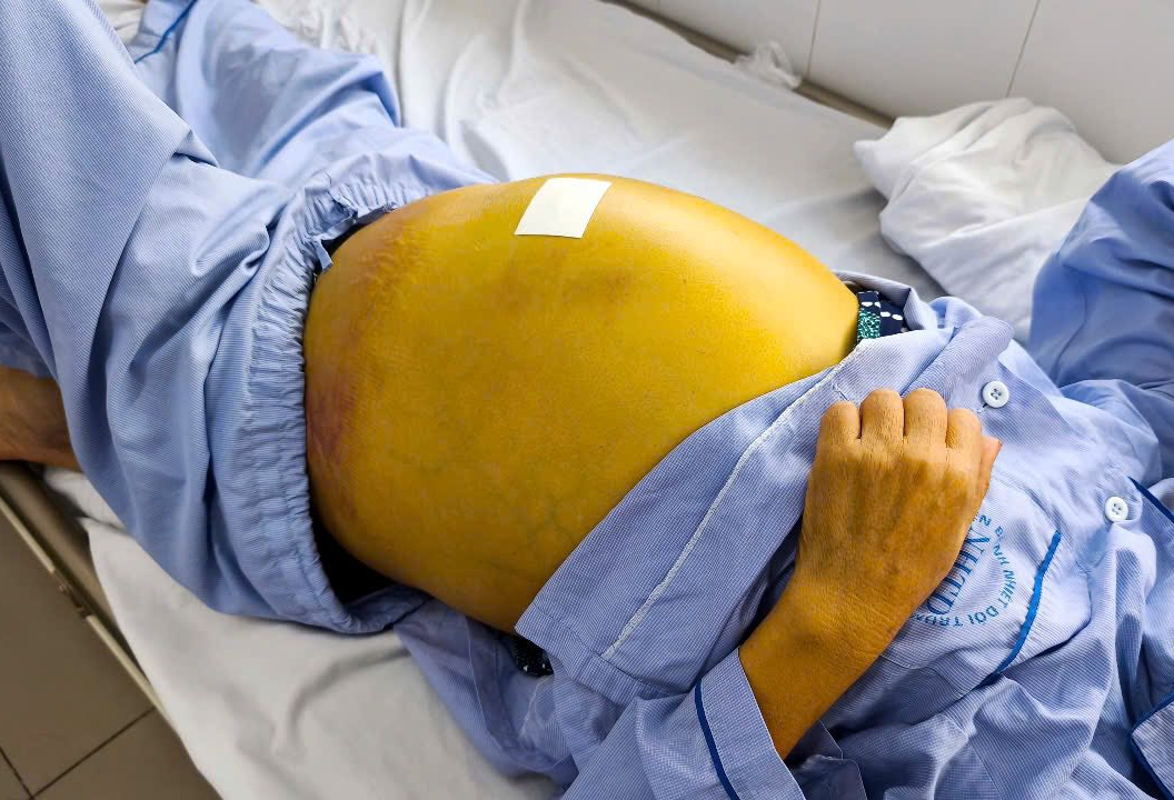 Người phụ nữ 61 tuổi suy gan nặng, nguy cơ tử vong cao do chủ quan với dấu hiệu này- Ảnh 1.