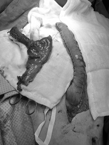 Người đàn ông 33 tuổi phải cắt bỏ thực quản vì làm 1 việc sai lầm này trong lúc say rượu- Ảnh 2. Người đàn ông 33 tuổi phải cắt bỏ thực quản vì làm 1 việc sai lầm này trong lúc say rượu- Ảnh 2.