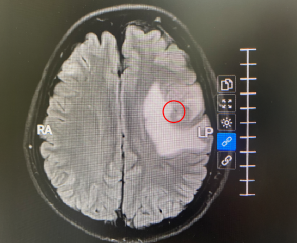 Người phụ nữ 45 tuổi bất ngờ phát hiện ung thư phổi di căn não từ dấu hiệu nhiều người Việt bỏ qua- Ảnh 1. Người phụ nữ 45 tuổi bất ngờ phát hiện ung thư phổi di căn não từ dấu hiệu nhiều người Việt bỏ qua- Ảnh 1.