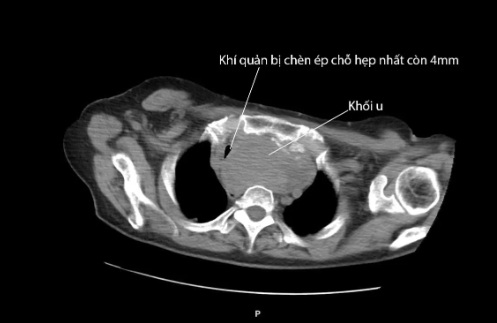 u-tuyen-giap-lanh-tinh-17552482496642092377570.jpg